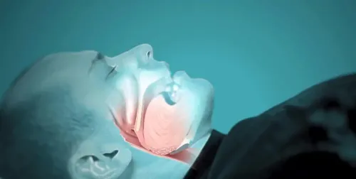 Tükürük Bezi Taşı Endoskopisi (Sialendoskopi)